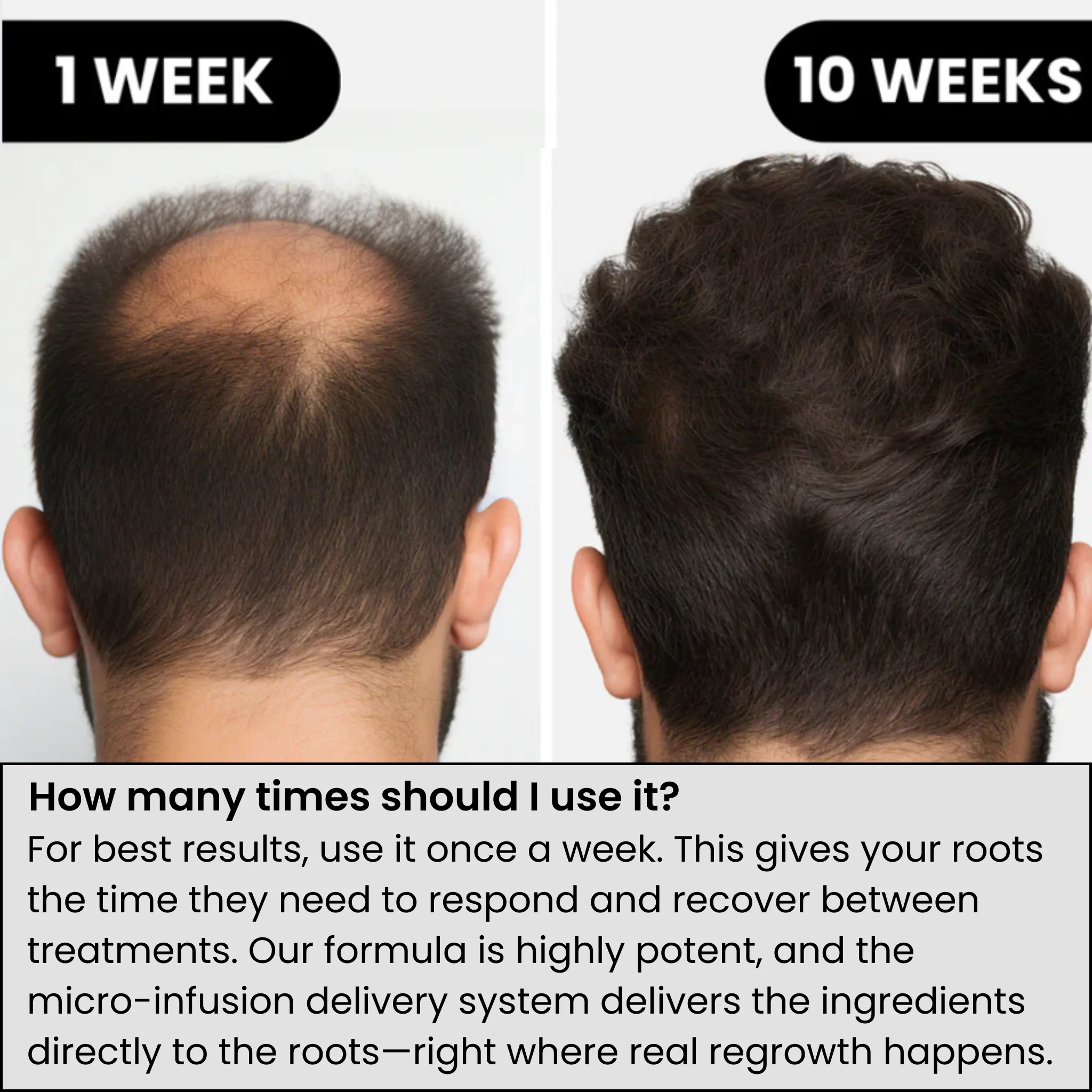 AlphaInfuse™ Hair Regrowth System - Image 3